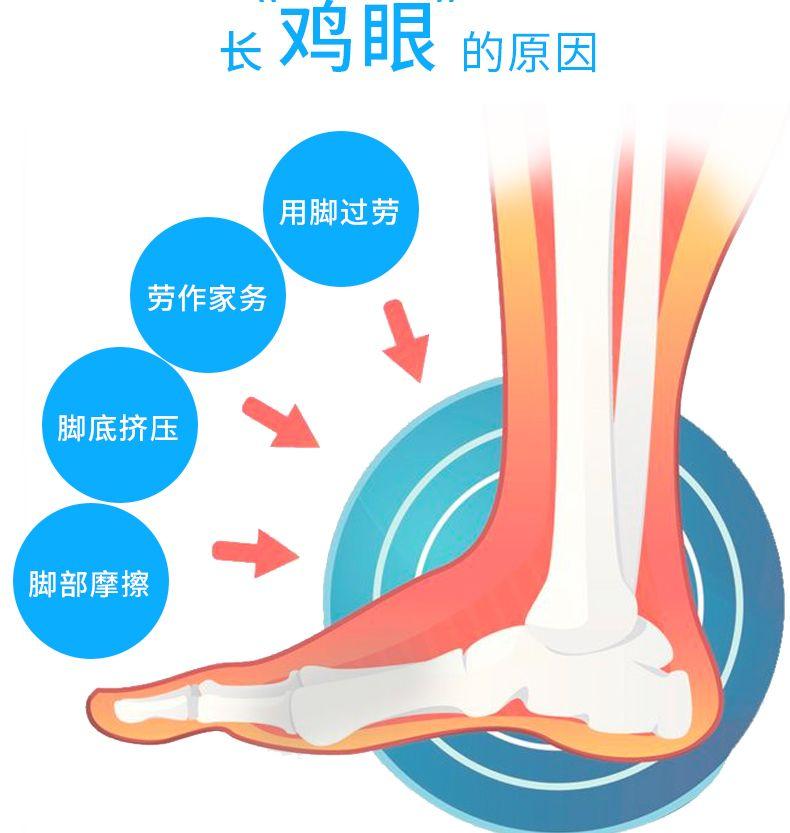 长鸡眼的原因 用脚过劳 劳作家务 脚底挤压 脚部摩擦 